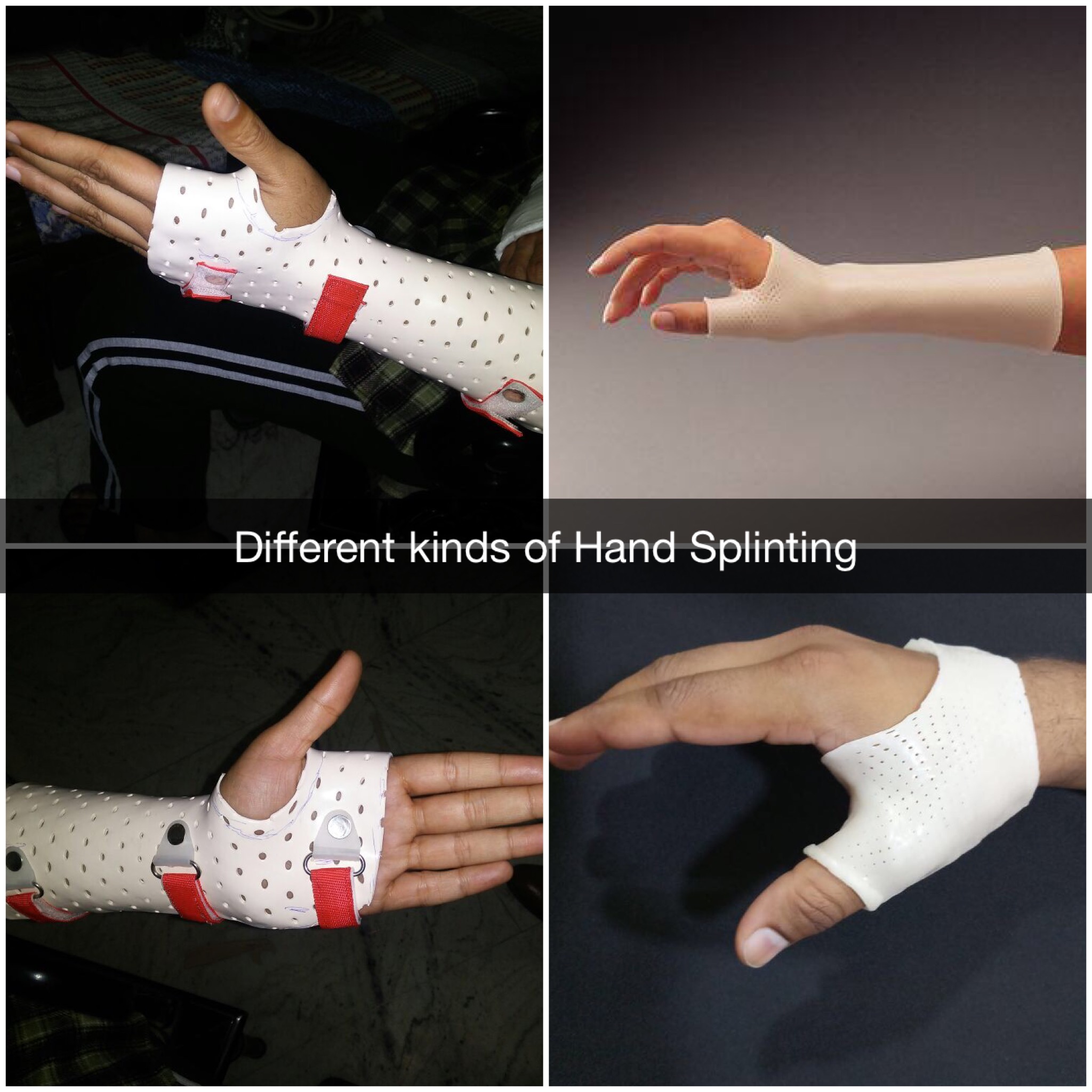 different hand splinting